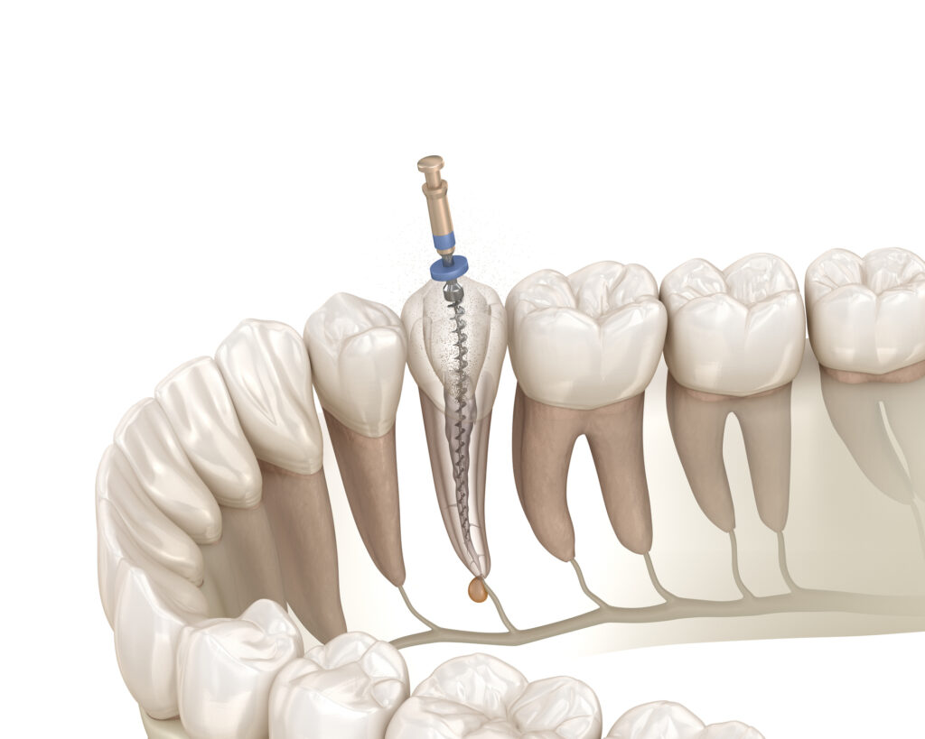 Diferencia entre empaste y endodoncia: todo lo que necesitas saber-Clínica Dental Manuel A. Tomillo Sánchez